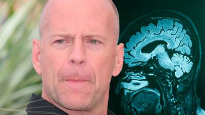 Bruce Willis es diagnosticado con demencia frontotemporal: ¿Qué es y cuáles son sus síntomas?