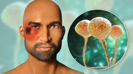 ¿Qué es el ‘hongo negro’ y cuáles son los síntomas de esta enfermedad en pacientes con COVID-19?
