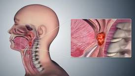 Virus del papiloma humano (VPH) ya es el factor de riesgo principal para el cáncer de garganta