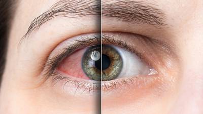 Ojo seco, el mal que afecta cada vez más a jóvenes y puede ocasionar la pérdida de la visión