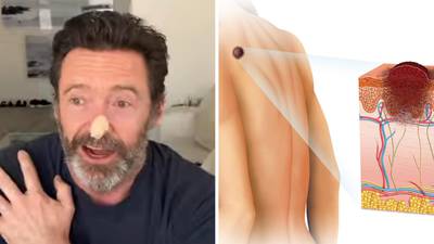 Hugh Jackman se somete a dos biopsias: ¿Cómo es el carcinoma que ha padecido el actor?