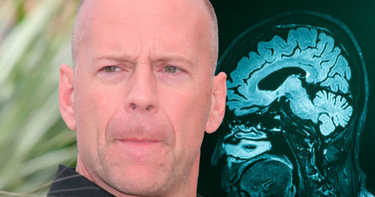 Bruce Willis es diagnosticado con demencia frontotemporal: ¿Qué es y cuáles son sus síntomas? – El Financiero