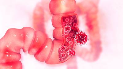 Día Mundial contra el cáncer de colón: ¿Cuáles son sus causas y síntomas? 