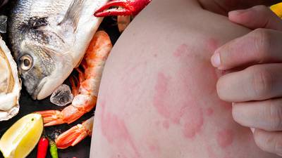 ¿Alergia a los mariscos? Estas son las pruebas que puedes realizarte para comprobarla