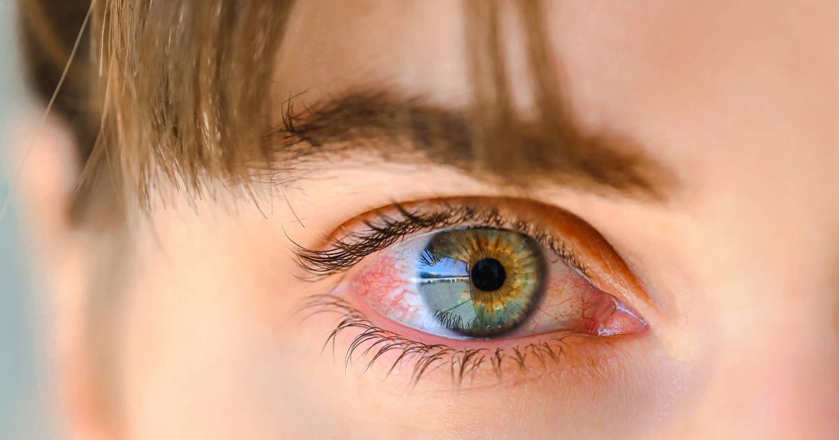 Síntomas y signos del cáncer de ojo que suele confundirse con una infección  – El Financiero