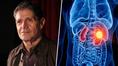 ¿Qué es el cáncer de riñón, padecimiento que tenía Héctor Bonilla?
