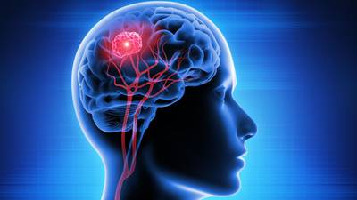 Cáncer cerebral: Estos son los síntomas y los tratamientos para la enfermedad