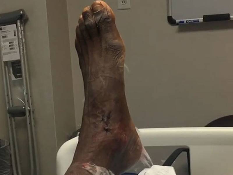 Las impactantes imágenes de la operación de tobillo de Jackson Martínez