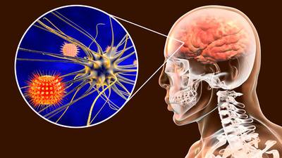 Meningitis: ¿Cuántos tipos hay y cuáles son sus síntomas y tratamientos?