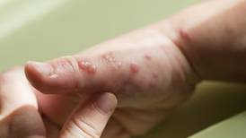 ¿Qué es el herpes, la enfermedad que padece el 70% de la población mundial?