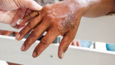 ¿Qué es la lepra y cuáles son los síntomas de la enfermedad?
