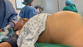 Extirpan tumor abdominal de 20 kilos a mujer en Perú; era ‘similar a un embarazo’, dicen doctores