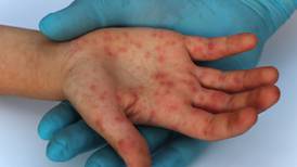 Reino Unido detecta ‘rara e inusual’ enfermedad: registra 7 casos de viruela símica