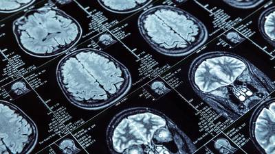 CHARM vs. el cáncer de cerebro: Así es la máquina con IA que ayuda a tratar la enfermedad