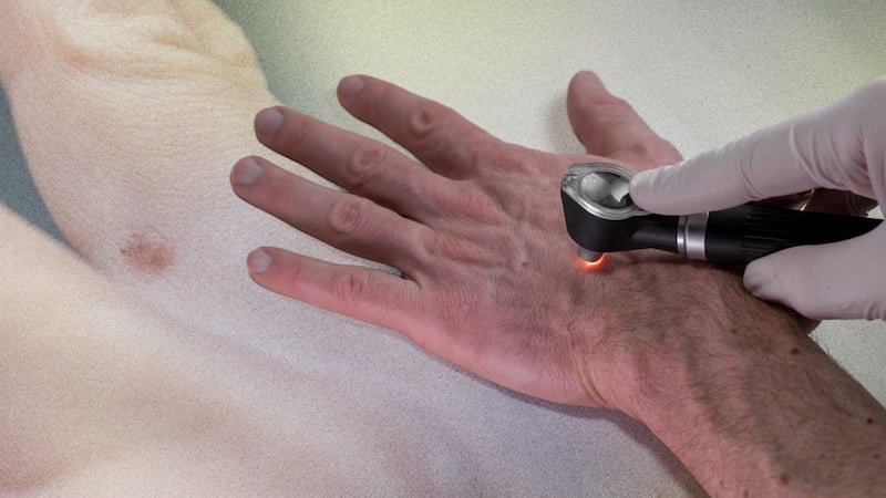 Esas manchas negras en tus manos podrían ser cáncer de piel: ¿Qué sabemos del melanoma acral?