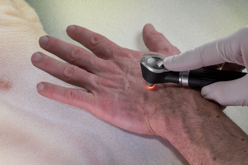 Esas manchas negras en tus manos podrían ser cáncer de piel: ¿Qué sabemos del melanoma acral?