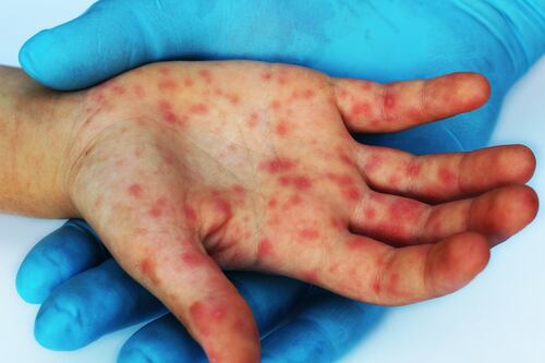 Virus coxsackie en México: ¿Cuáles son los síntomas y qué sabemos de los contagios en niños?