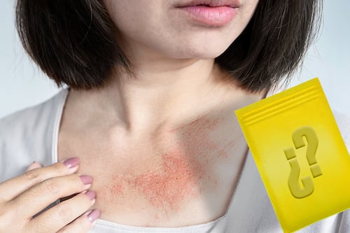 ¿El calorón te pone ‘roñoso’? 7 tips para tratar el sarpullido o miliaria por altas temperaturas