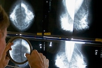 ¿Por qué la pandemia de COVID-19 redujo la supervivencia de pacientes con cáncer? Esto dice un estudio