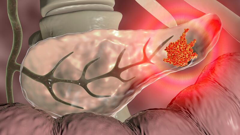 ¿Qué es el cáncer de páncreas, la enfermedad que padece el fiscal Gertz Manero?