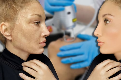 Mejor que un facial: El tratamiento que dermatólogos usan para atenuar manchas de acné y mejorar la piel