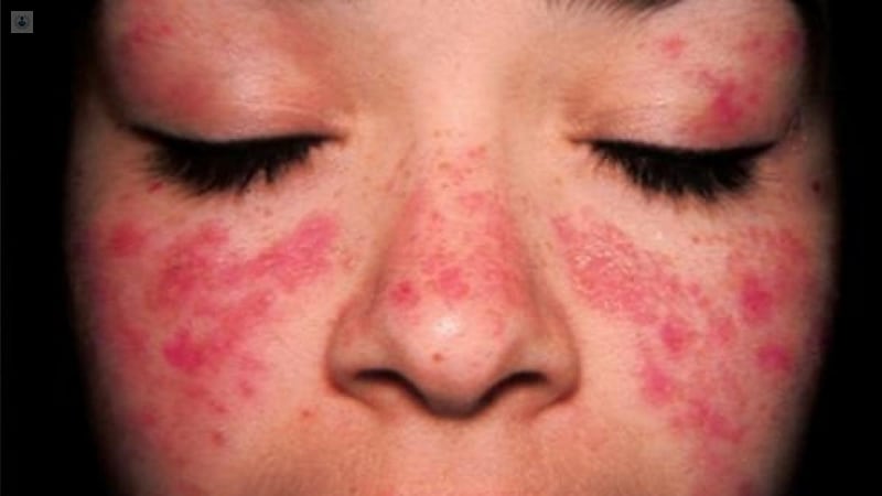Lupus: El ABC para entender la enfermedad y la novedosa terapia que podía salvar a millones