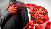 ¿Te contagiaste de COVID? Riesgo de coágulos sanguíneos es 33 veces mayor