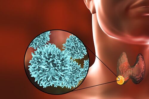 Cáncer de tiroides: Estos son sus cinco tipos y etapas de desarrollo