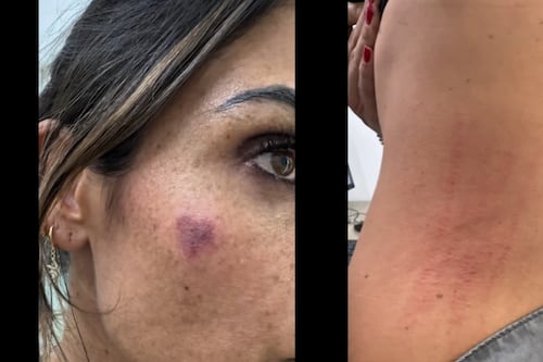 ‘Para que quede evidencia’: Así fue la agresión contra Alessandra Rojo y las lesiones que mostró (Video)