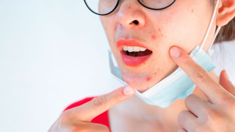 Acné afecta al 80% de los mexicanos; uso de cubrebocas aumentó el padecimiento