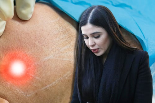 Emma Coronel se somete a procedimiento estético: ¿Qué es el endolift y para qué sirve?