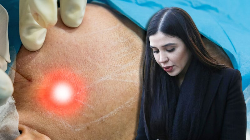 Emma Coronel se somete a procedimiento estético: ¿Qué es el endolift y para qué sirve?