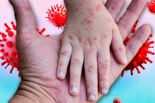 Sarampión en Tlaxcala: Muere un menor por complicaciones y falta de esquema de vacunación completo