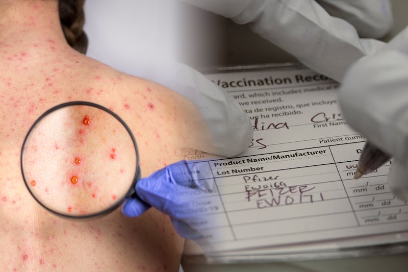 Brote de sarampión: ¿Te puedes vacunar si no tienes tu cartilla de salud y naciste en los 80′?