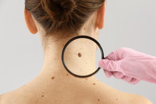 Cáncer de piel: ¿Cuáles son las causas y síntomas de su aparición?