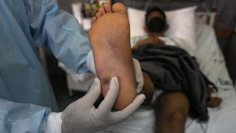 Jalisco registra 23 nuevos casos de viruela del mono