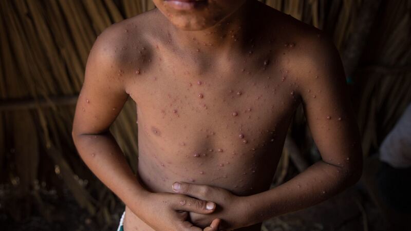 Detectan brote de varicela en campamentos migrantes en El Paso, Texas