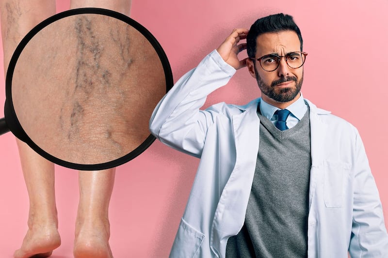 ¿Qué son las várices, por qué aparecen y cuáles son los nuevos tratamientos sin cirugía para eliminarlas?