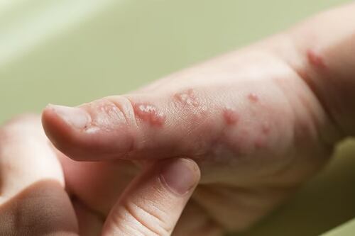 ¿Qué es el herpes, la enfermedad que padece el 70% de la población mundial?