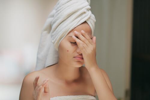 ¿El acné afecta la salud mental de los adolescentes mexicanos? Esto dicen especialistas