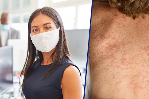 ¿Sirve el cubrebocas contra el sarampión? Eduardo Clark explica efectividad contra el virus