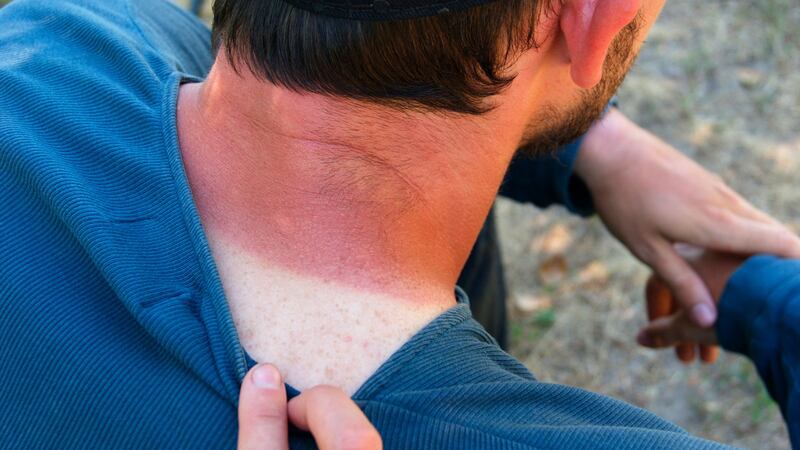 Onda de calor: ¿Qué pasa si sales a la calle sin usar bloqueador solar?