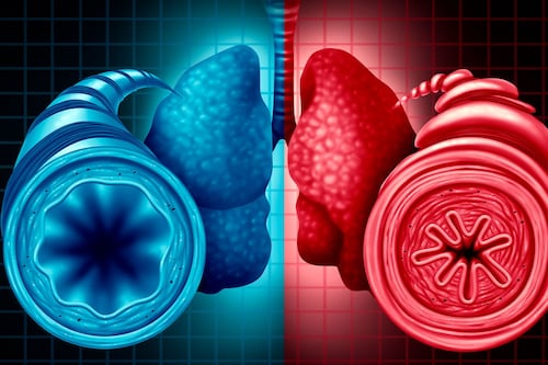 ¿Qué es y qué provoca el asma?: Estos son sus síntomas y causas