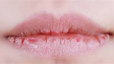 Síntomas inusuales de COVID-19: ¿Por qué la boca seca se relaciona con coronavirus?